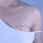 Virus respiratorios pueden provocar la metástasis pulmonar del cáncer de mama