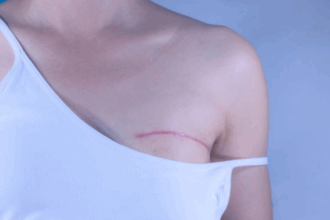 Virus respiratorios pueden provocar la metástasis pulmonar del cáncer de mama