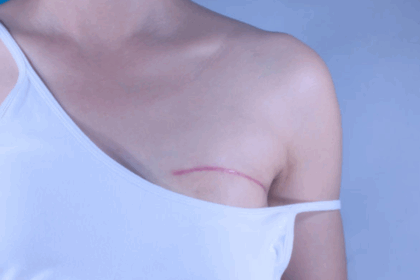 Virus respiratorios pueden provocar la metástasis pulmonar del cáncer de mama