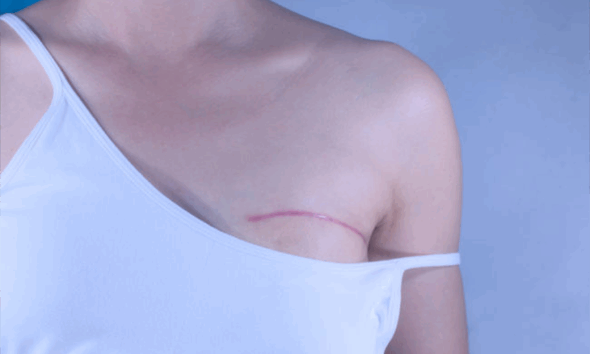 Virus respiratorios pueden provocar la metástasis pulmonar del cáncer de mama