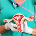 **Más de 300 casos de cáncer de cérvix en Incart en tres años: alertan sobre prevención** El cáncer de cuello uterino continúa siendo la segunda enfermedad más frecuente en mujeres, a pesar de ser prevenible mediante detección temprana y vacunación contra el Virus del Papiloma Humano (VPH). * Entre 2023 y 2025, el Instituto Nacional del Cáncer Rosa Emilia Sánchez Pérez de Tavares (Incart) registró 323 casos de cáncer de cérvix, con 110 solo en 2024. * El principal factor de riesgo es la infección persistente por VPH, aunque influyen múltiples parejas sexuales y estilos de vida poco saludables. * La detección temprana mediante Papanicolau, Papanicolau de base líquida y pruebas biomoleculares permite tratamientos simples como crioterapia o conización. Los diagnósticos tardíos requieren terapias más agresivas con menor probabilidad de éxito. * La vacuna contra el VPH, incluida la reciente nonavalente que protege contra nueve tipos de virus, es la herramienta más efectiva para prevenir la enfermedad. Sin embargo, la desinformación y resistencia a la vacunación limitan su cobertura. El especialista César del Orbe enfatizó la importancia de combinar educación en salud, vacunación y chequeos periódicos para reducir la incidencia y la mortalidad por cáncer de cuello uterino. #CáncerDeCérvix #PrevenciónVPH #SaludMujer #Incart #ChequeosGinecológicos #VacunaVPH